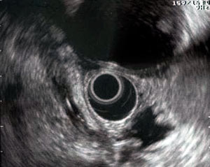 Colangiocarcinoma evidenziato con EUS