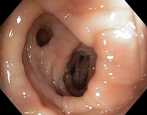 Diverticoli del colon