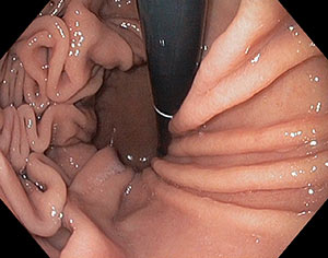 Ernia iatale da scivolamento