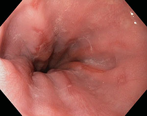 Esofagite da reflusso