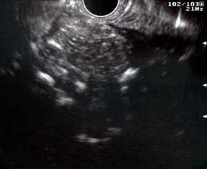 Pancreatite cronica alla EUS